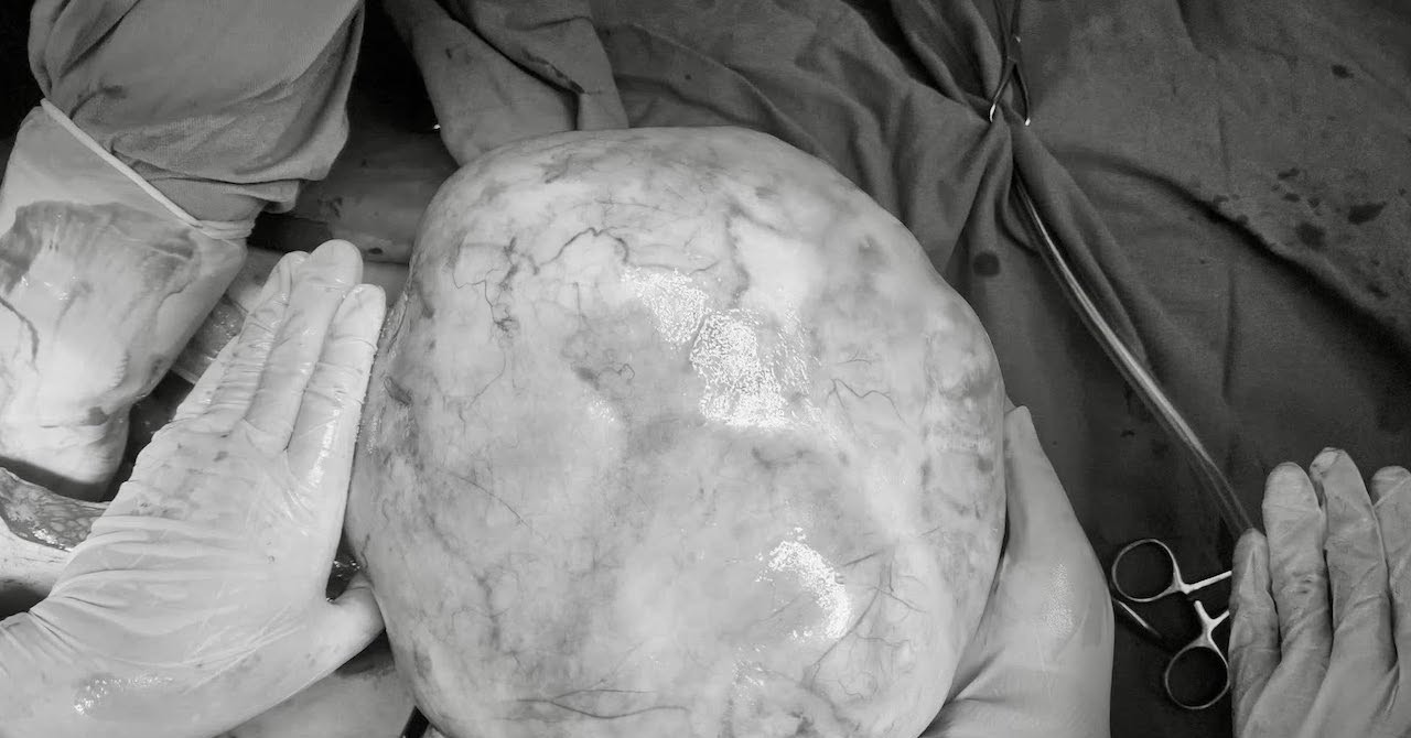 Bé gái 14 tuổi mang khối u khủng, dấu hiệu dễ nhầm với tăng cân tuổi dậy thì