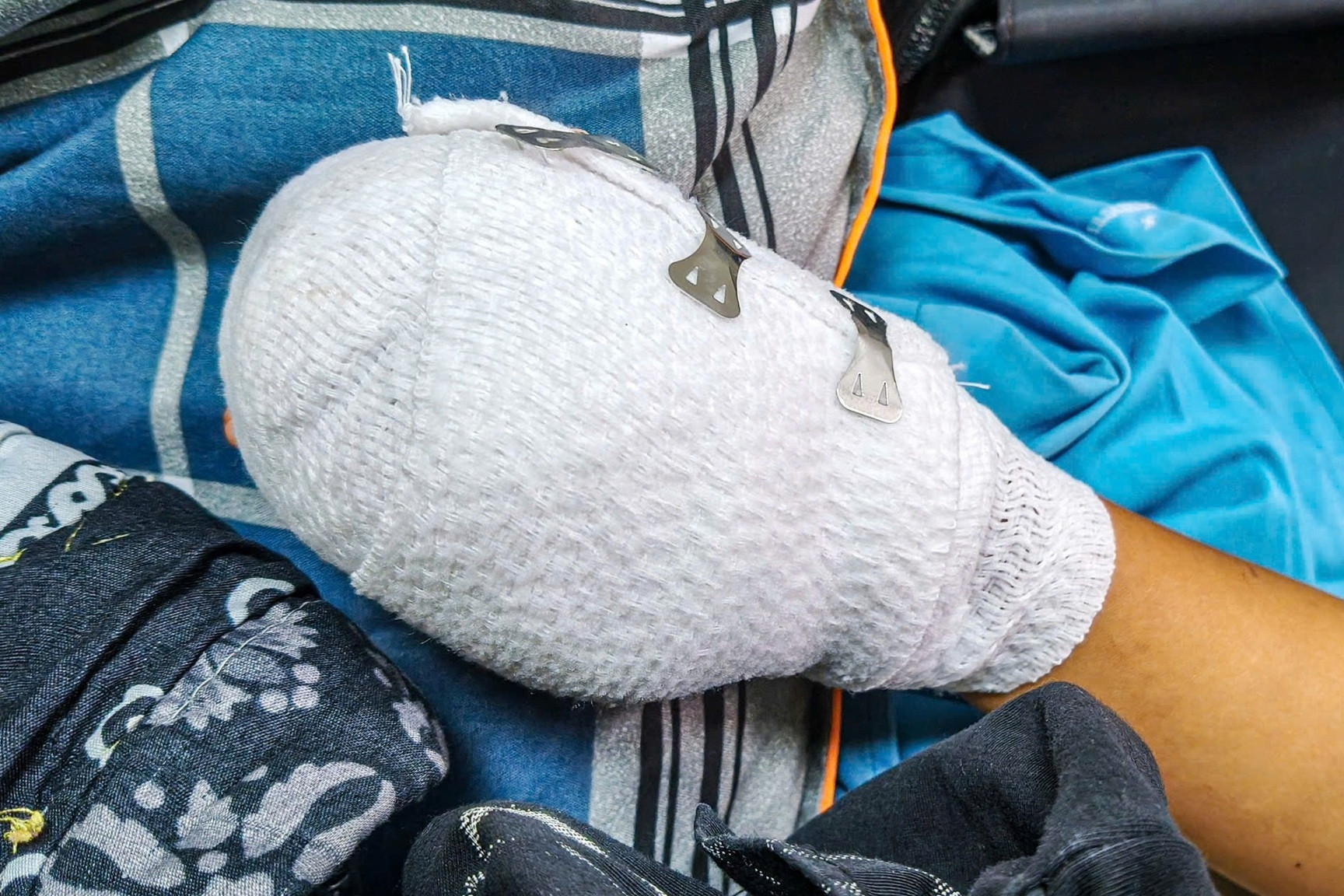 Bé trai 9 tuổi nhập viện với chấn thương nặng vùng tay, bụng, nghi do điện thoại nổ