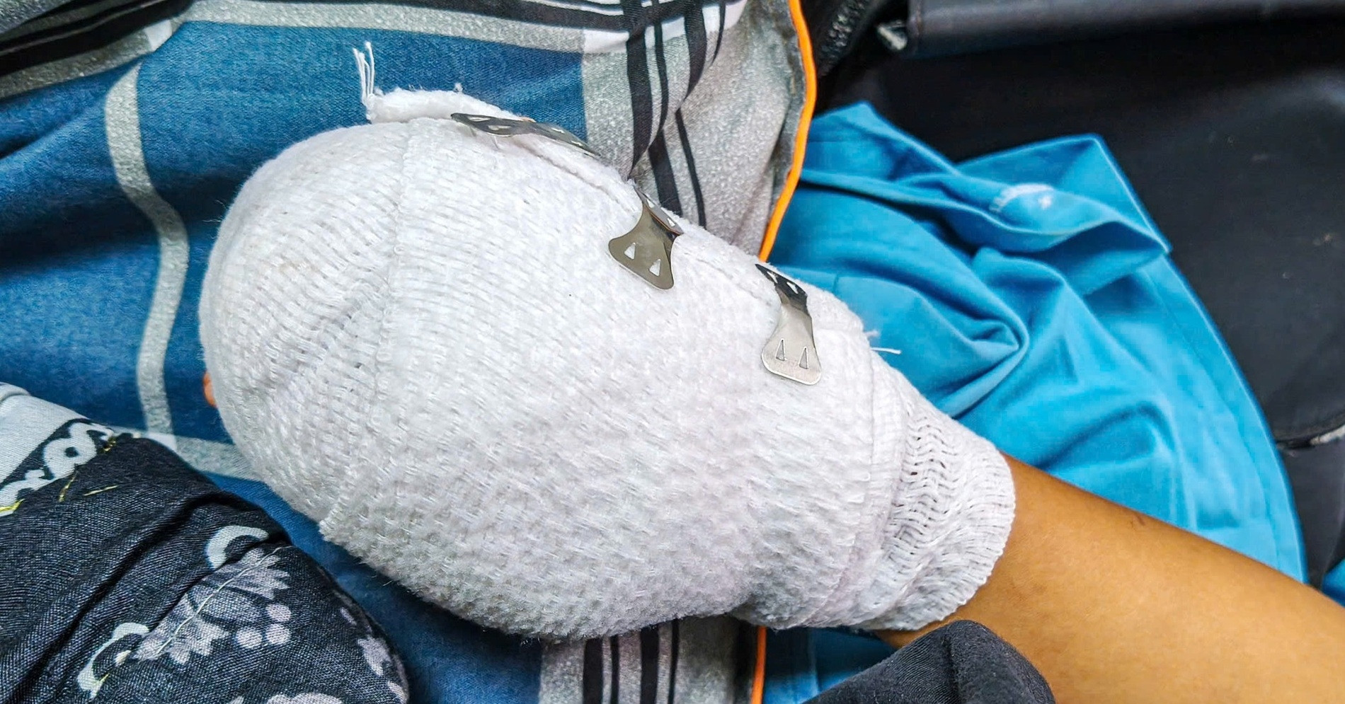 Bé trai 9 tuổi nhập viện với chấn thương nặng vùng tay, bụng, nghi do điện thoại nổ