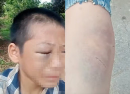 bé trai nghi bị bạo hành.jpg