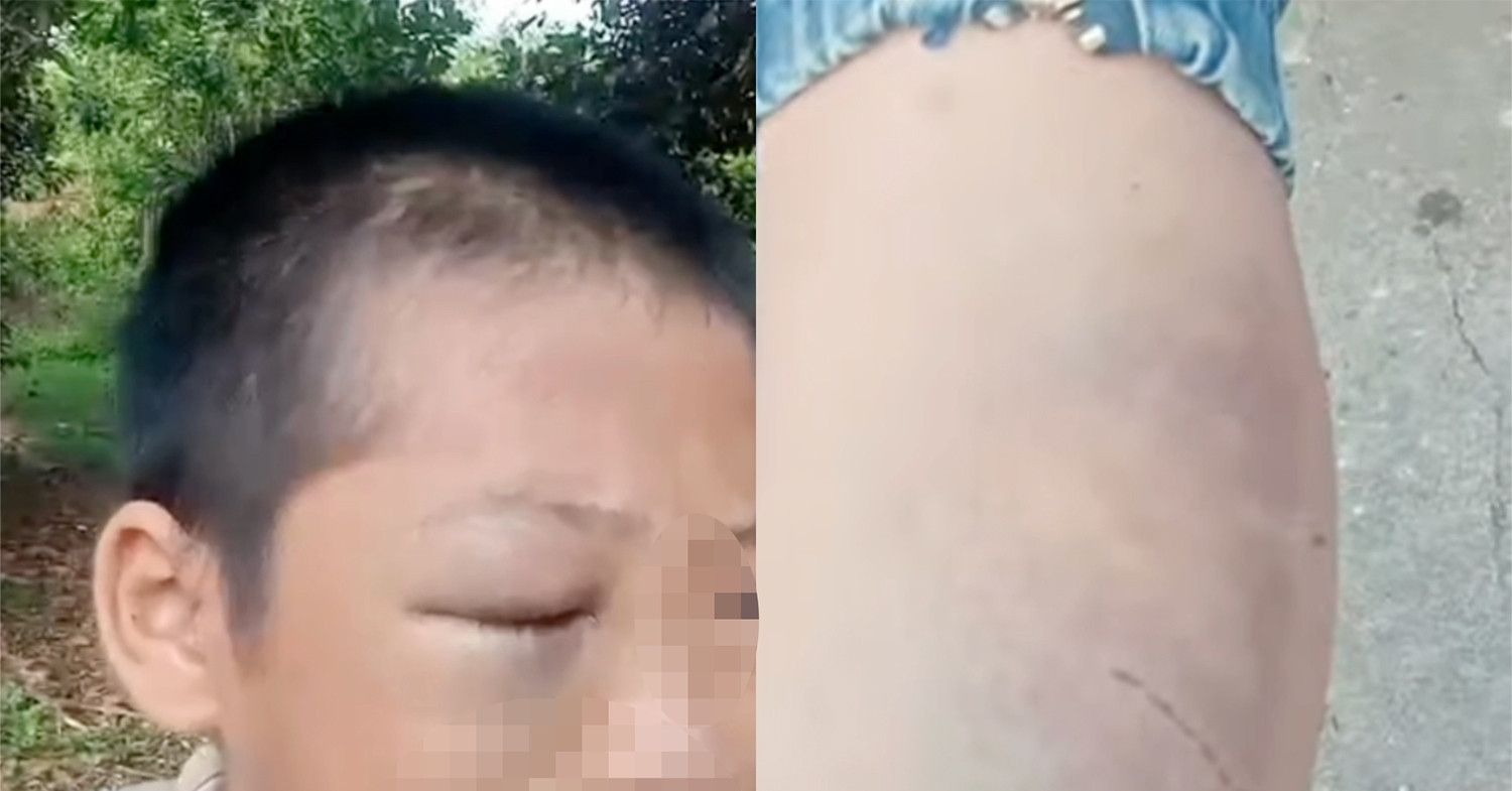 Xác minh clip bé trai mắt bầm tím, khóc kêu cứu vì &amp;apos;nhiều lần bị đánh đập&amp;apos;