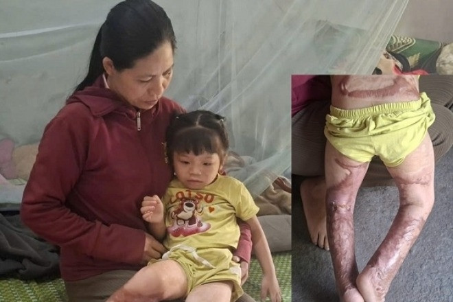 Xót xa bé gái 4 tuổi trải qua 12 cuộc phẫu thuật sau vụ bỏng xăng kinh hoàng