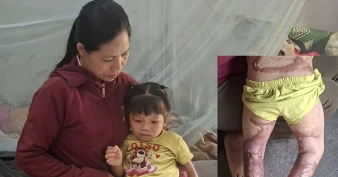 Bé gái 4 tuổi trải qua 12 cuộc phẫu thuật sau vụ bỏng xăng kinh hoàng