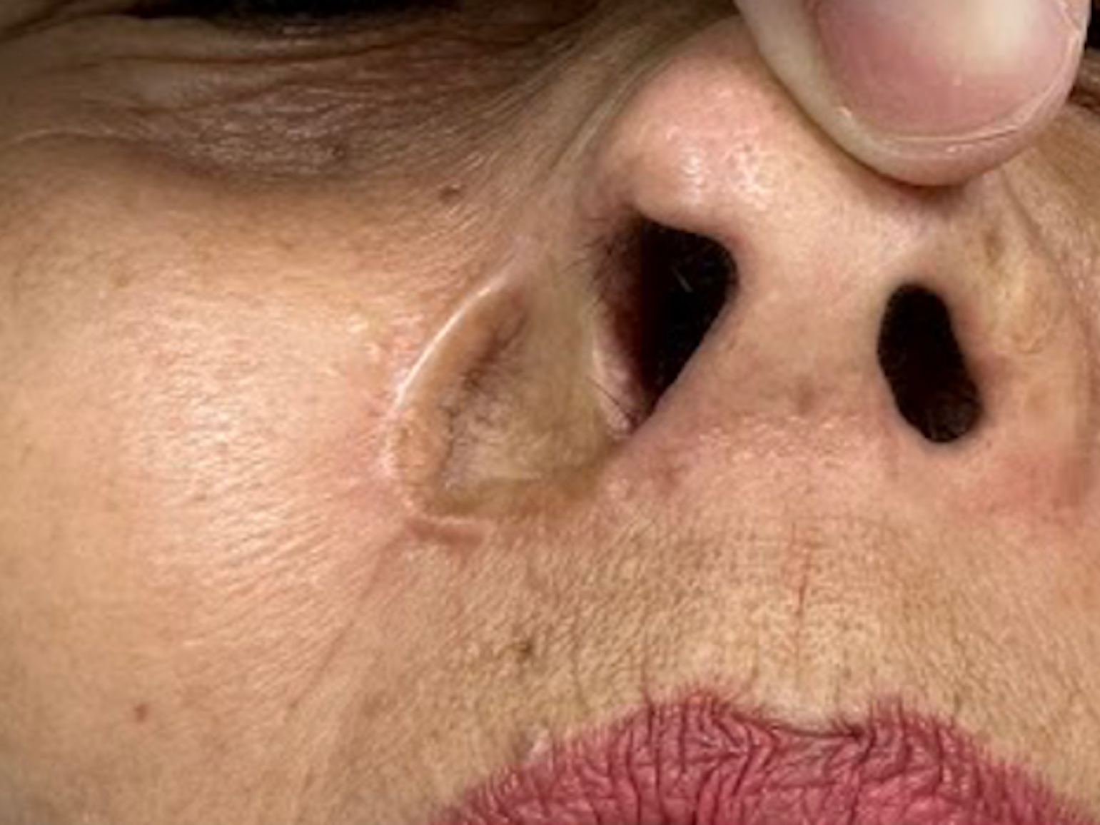 Khoảnh khắc vỡ òa của người phụ nữ có nốt ruồi hóa ung thư, phá hủy cánh mũi https://static-images.vnncdn.net/vps_images_publish/000001/000003/2026/5/17/khoanh-khac-vo-oa-cua-nguoi-phu-nu-co-not-ruoi-hoa-ung-thu-pha-huy-canh-mui-615.png