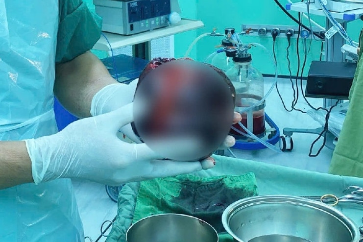 Chủ quan đau bụng nhẹ, người đàn ông suýt mất mạng vì khối u bằng quả dưa lưới