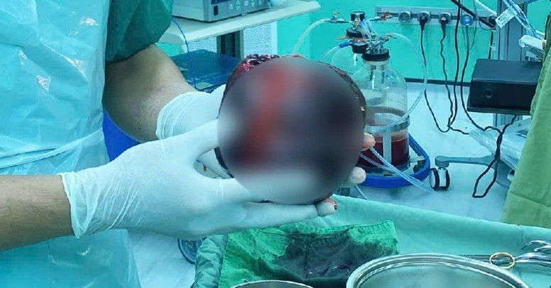 Chủ quan đau bụng nhẹ, người đàn ông suýt mất mạng vì khối u bằng quả dưa lưới