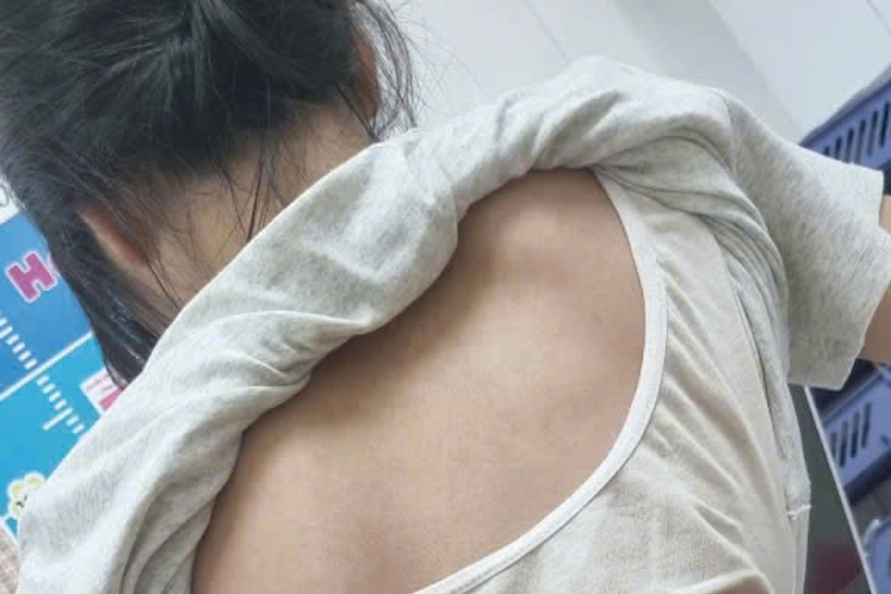 Cột sống thiếu nữ 'uốn lượn' hình chữ S, bác sĩ chỉ ra sai lầm nhiều người mắc