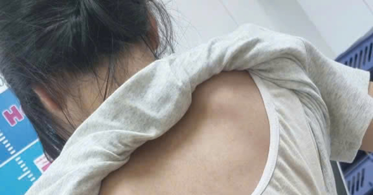 Cột sống thiếu nữ "uốn lượn" hình chữ S, bác sĩ chỉ ra sai lầm nhiều người mắc