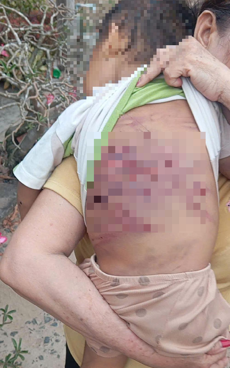 tinh trang suc khoe be trai bi me ruot va cha duong bao hanh da man o tphcm 2426.png