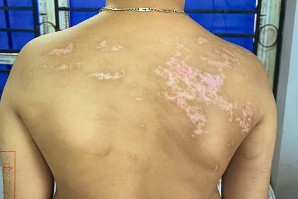 Bắt tạm giam người bố bạo hành con trai hơn 7 tuổi ở Phú Thọ