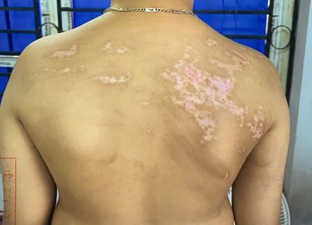 Thương tích của cháu Nguyễn Đình Bảo Khánh 4__2e7d636e8e.jpg