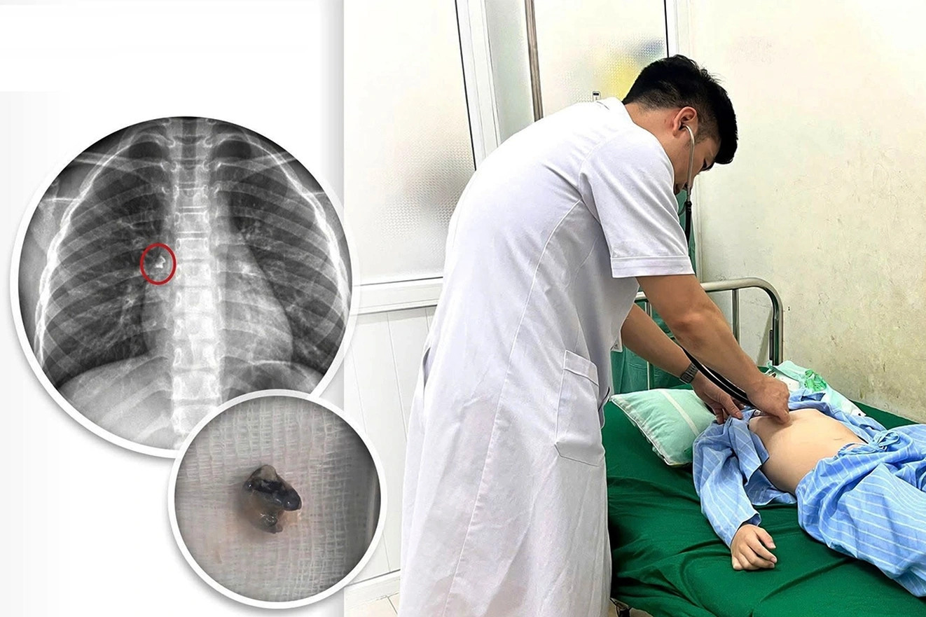 Được mẹ nhổ răng tại nhà, bé trai phải đi cấp cứu sau sự cố hi hữu