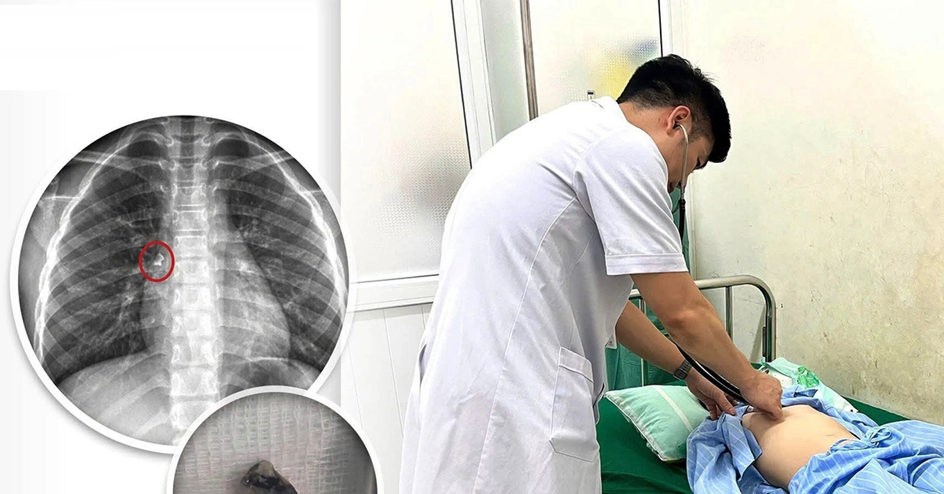 Được mẹ nhổ răng tại nhà, bé trai phải đi cấp cứu sau sự cố hi hữu