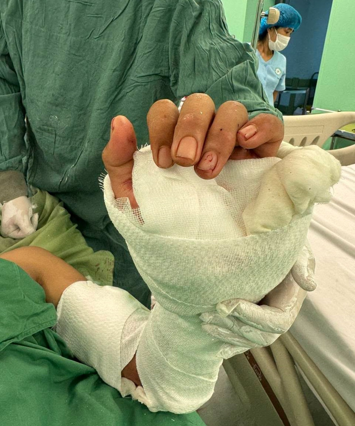 6 giờ nối thành công bàn tay đứt lìa cho nam thanh niên bị máy cưa cắt..jpg