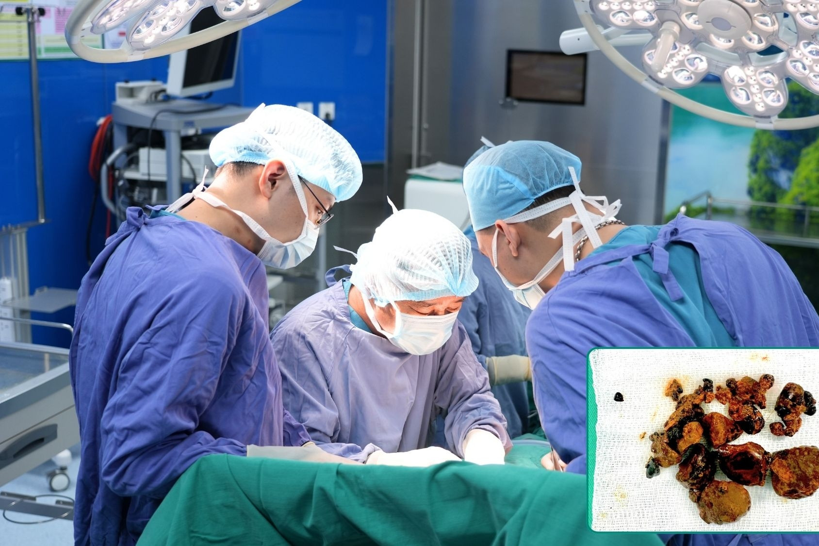 Chiến lược phẫu thuật an toàn cho bệnh nhân sỏi mật phức tạp tại BVĐK Hồng Ngọc