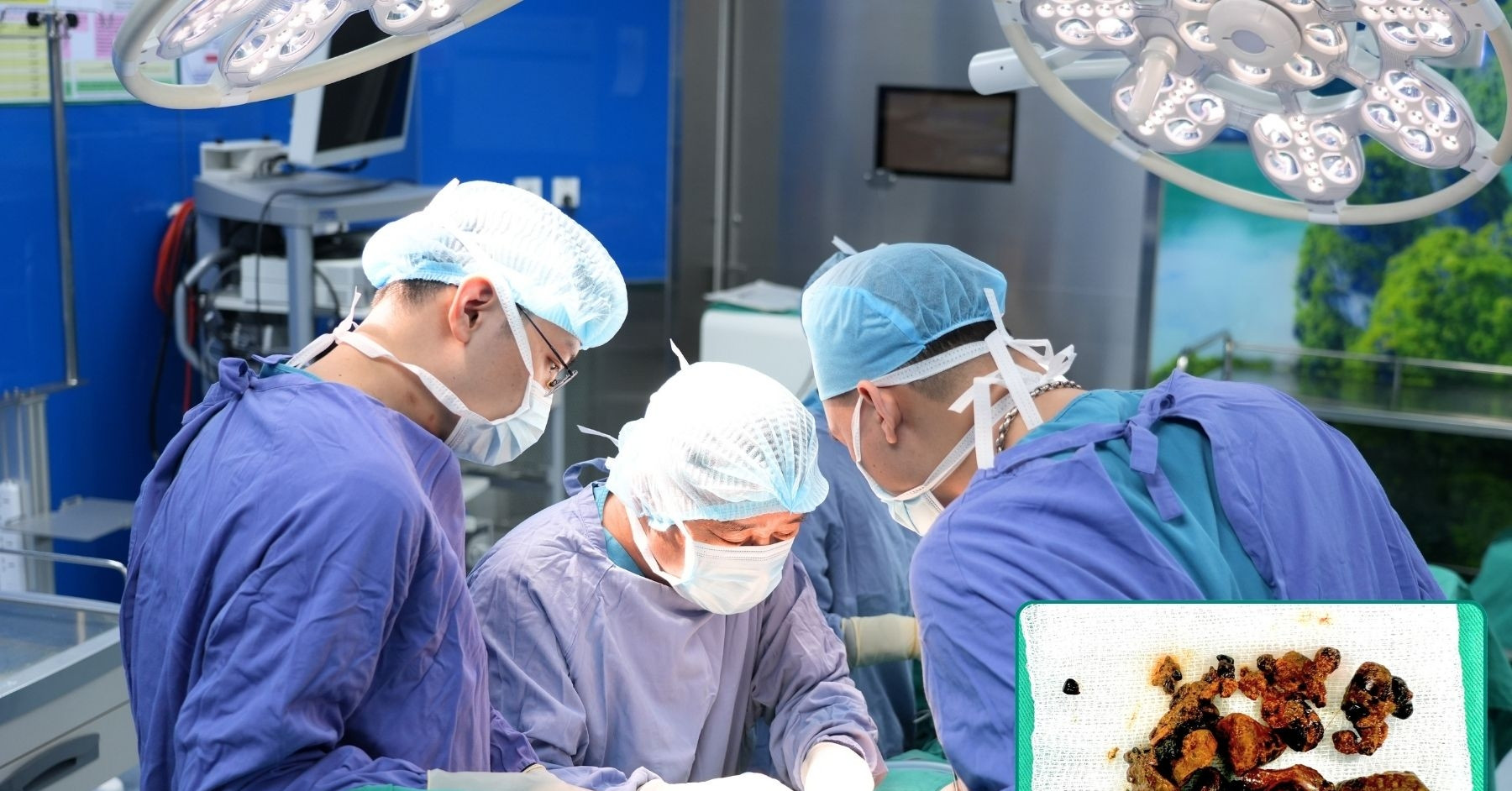Chiến lược phẫu thuật an toàn cho bệnh nhân sỏi mật phức tạp tại BVĐK Hồng Ngọc