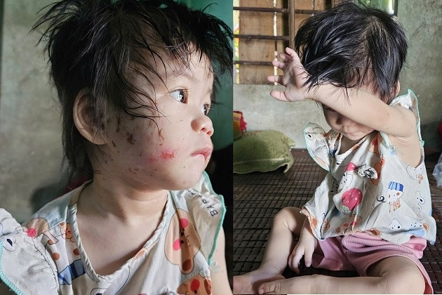 Bé gái gần 2 tuổi chưa có giấy khai sinh sống cùng mẹ và cậu mắc bệnh tâm thần
