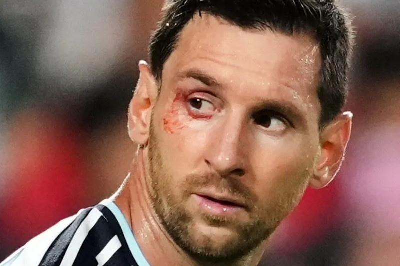 Messi bị chảy máu ngay mắt sau cú va chạm với đội trưởng Thụy Sĩ