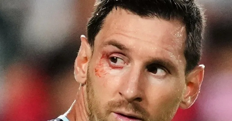 Messi bị chảy máu ngay mắt sau cú va chạm với đội trưởng Thụy Sĩ