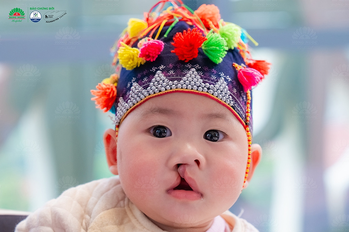 Bệnh viện Hồng Ngọc phẫu thuật miễn phí cho trẻ mắc dị tật hở môi - vòm miệng