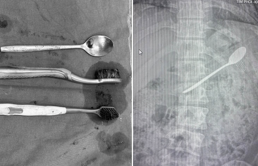 Tìm thấy nhiều bàn chải đánh răng, thìa inox trong dạ dày nam thanh niên Hà Nội