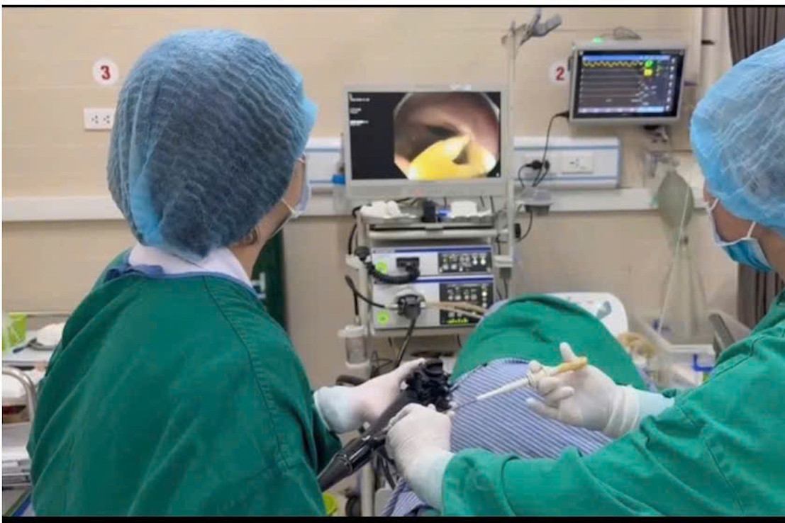 Phát hiện sán dây 1,2m trong ruột người đàn ông có thói quen ăn thịt bò tái