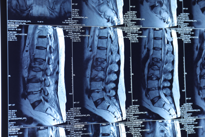 HÌNH ẢNH MRI VỊ TRÍ CHÈN ÉP VÀ ÁP XE CỘT SỐNG.png