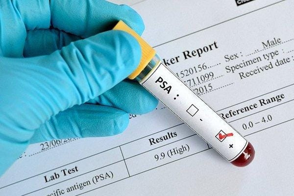 Nam giới từ 40 tuổi cần làm một xét nghiệm để sàng lọc ung thư tuyến tiền liệt