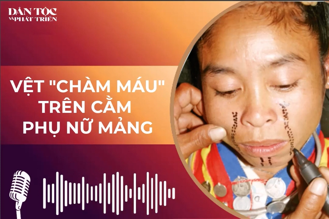 Vệt “chàm máu” trên cằm phụ nữ Mảng