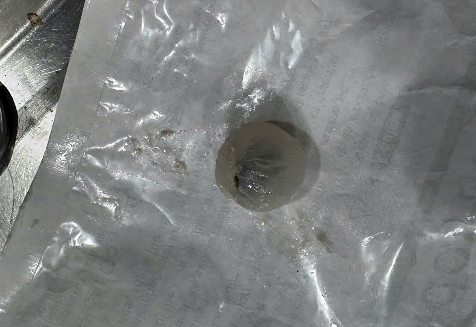 Quả nhãn mắc kẹt ở khí quản bệnh nhân.jpg