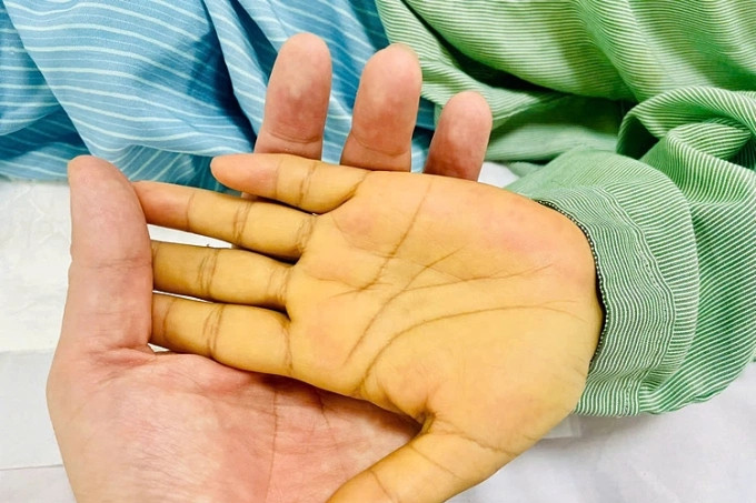 Tuổi 23 bàng hoàng với căn bệnh ác tính 'không còn làm gì được nữa'
