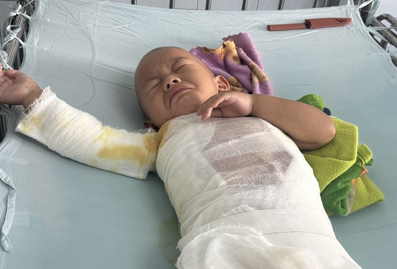 Mong cộng đồng giúp đỡ bé trai vùng cao ngã vào nồi nước sôi bị bỏng nặng