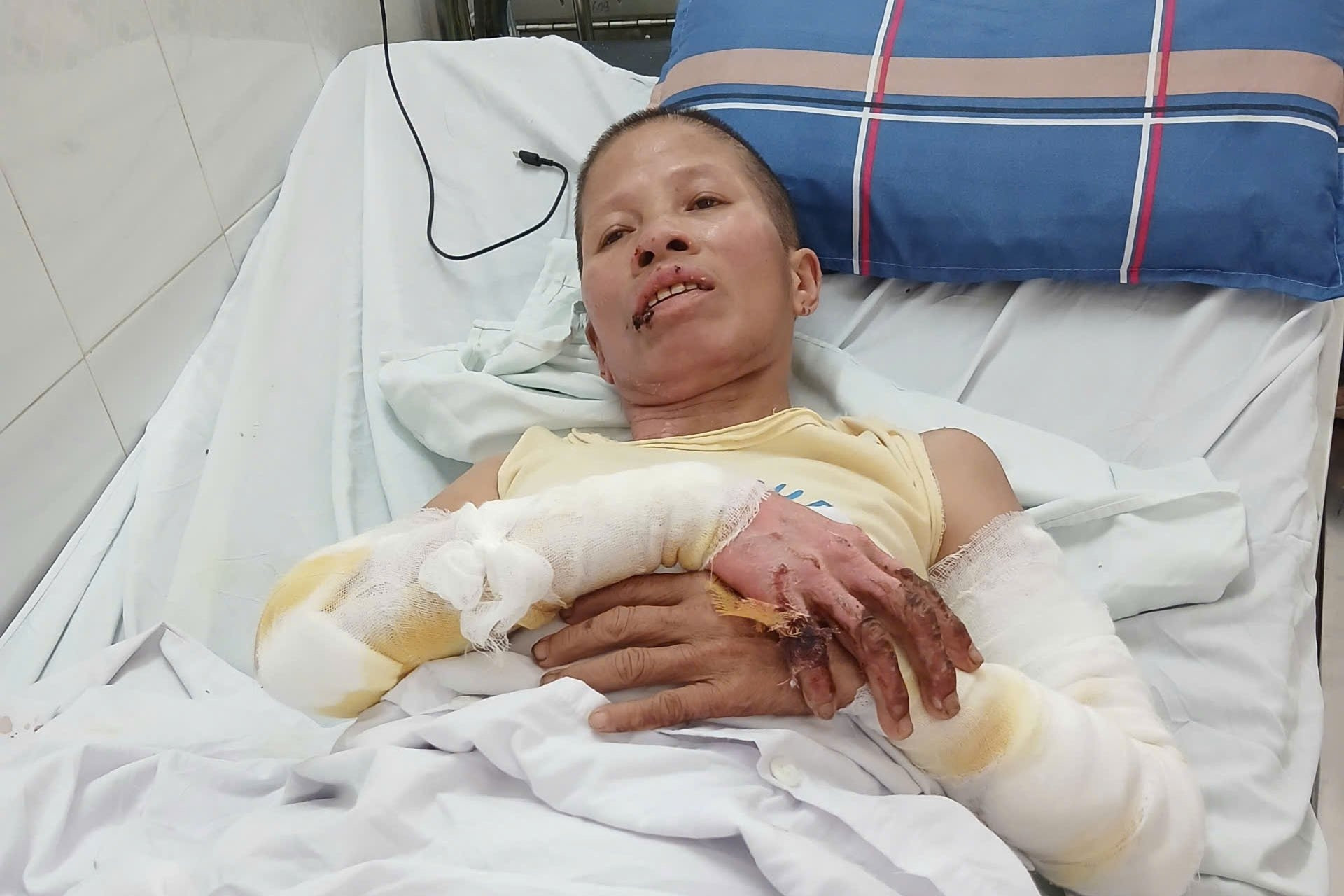 Mẹ vừa qua đời, người phụ nữ đơn thân bị bỏng nặng khi cúng cơm