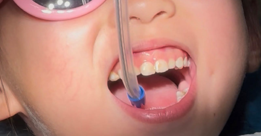 Lý do tiến sĩ dược làm việc ở Mỹ đưa con về Việt Nam chữa răng sâu