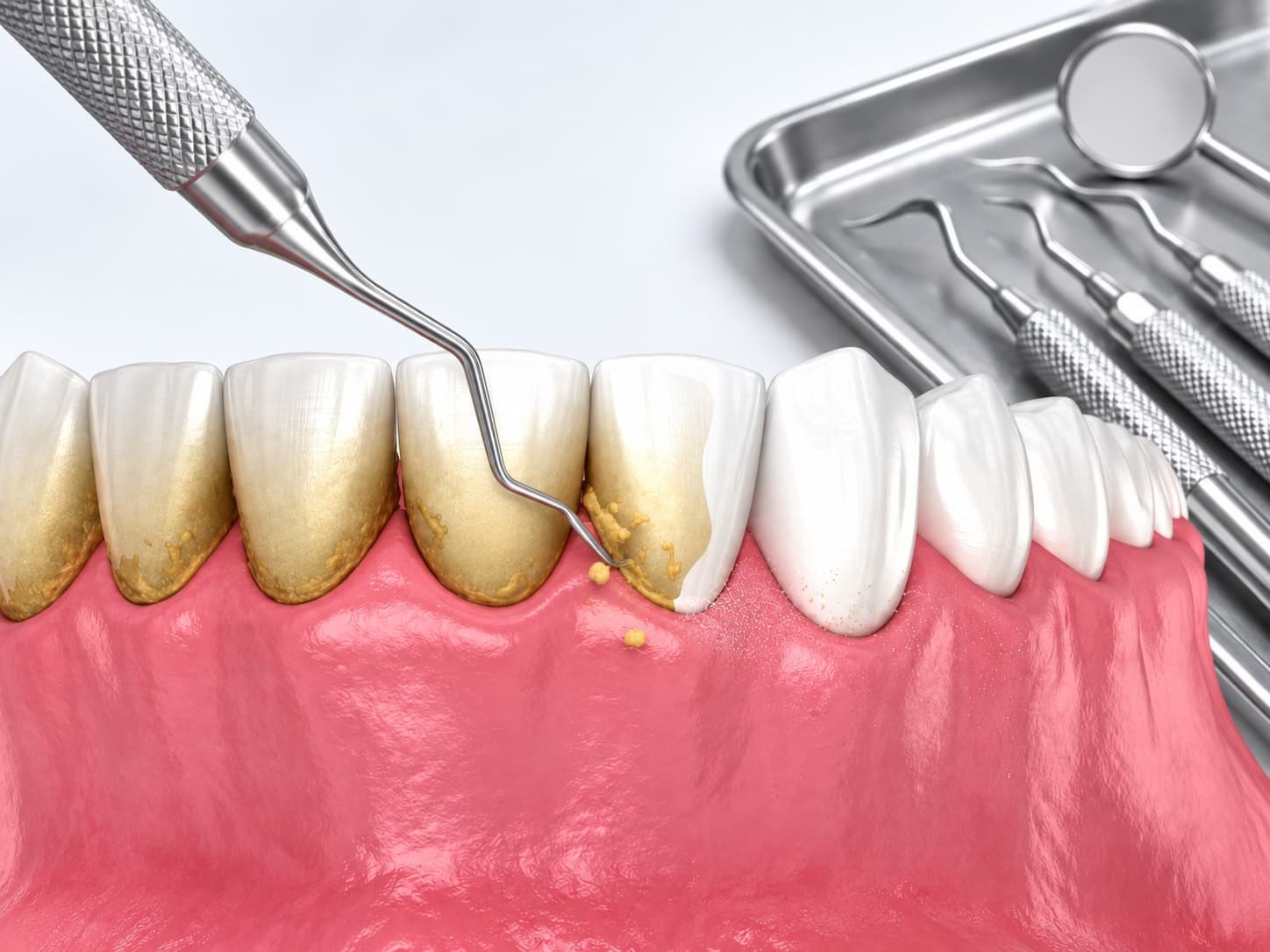 lấy cao răng có được hưởng bảo hiểm y tế không.jpg