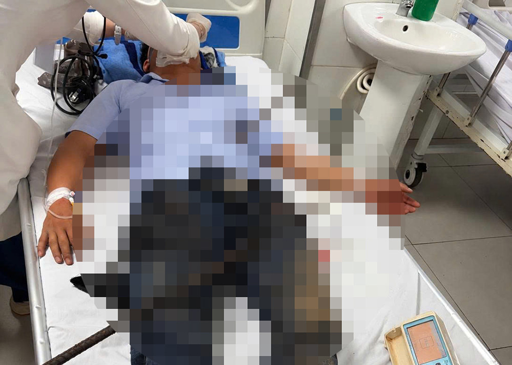 Hình ảnh bệnh nhân lúc nhập viện với 2 thanh sắt xuyên qua 2 đùi.jpg