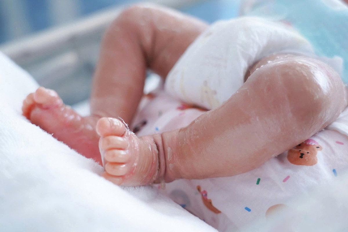Bé trai sơ sinh da như vảy cá, mi mắt lộn ngược
