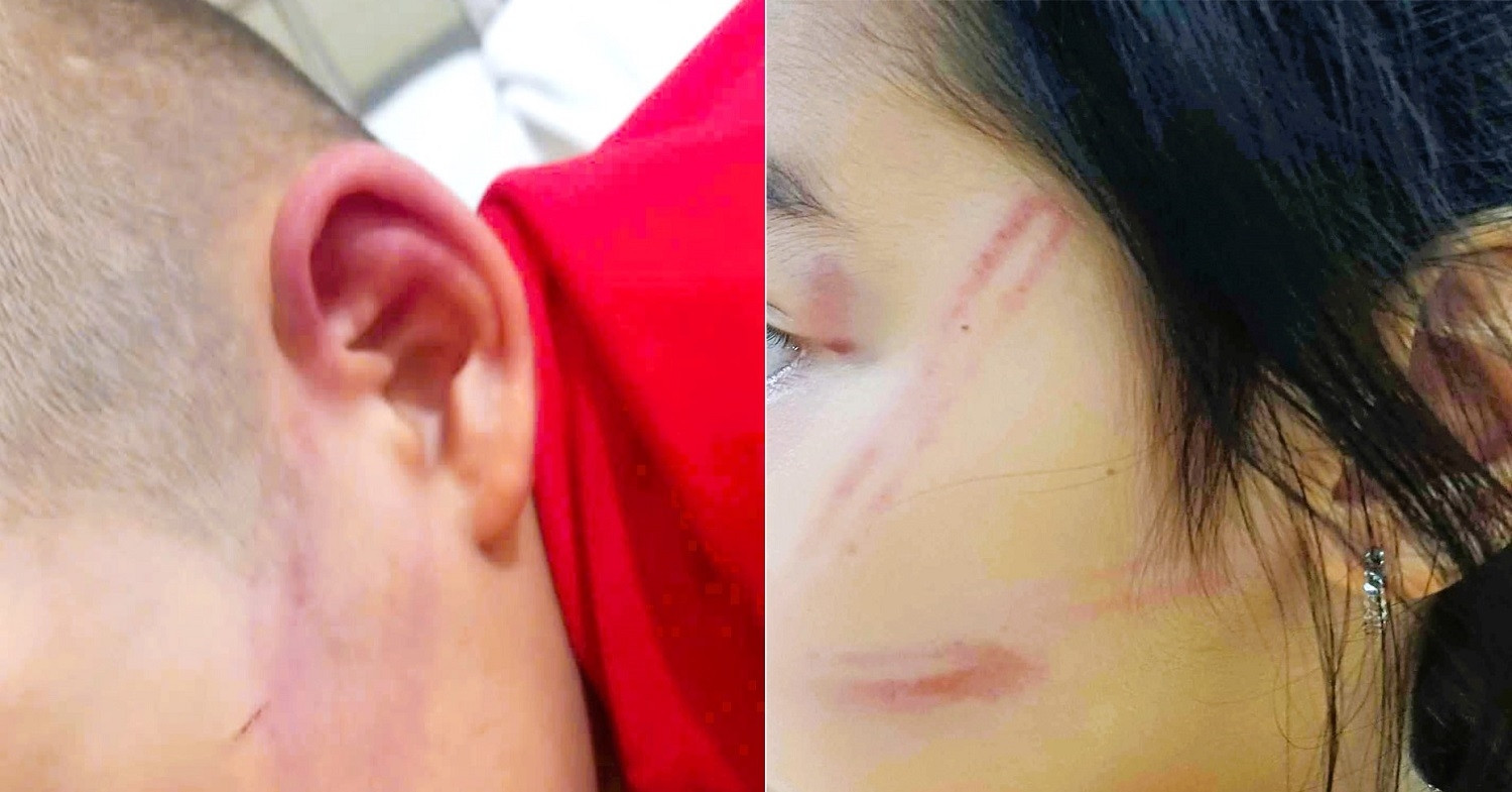 Investigation underway after six children found bruised in Nghe An