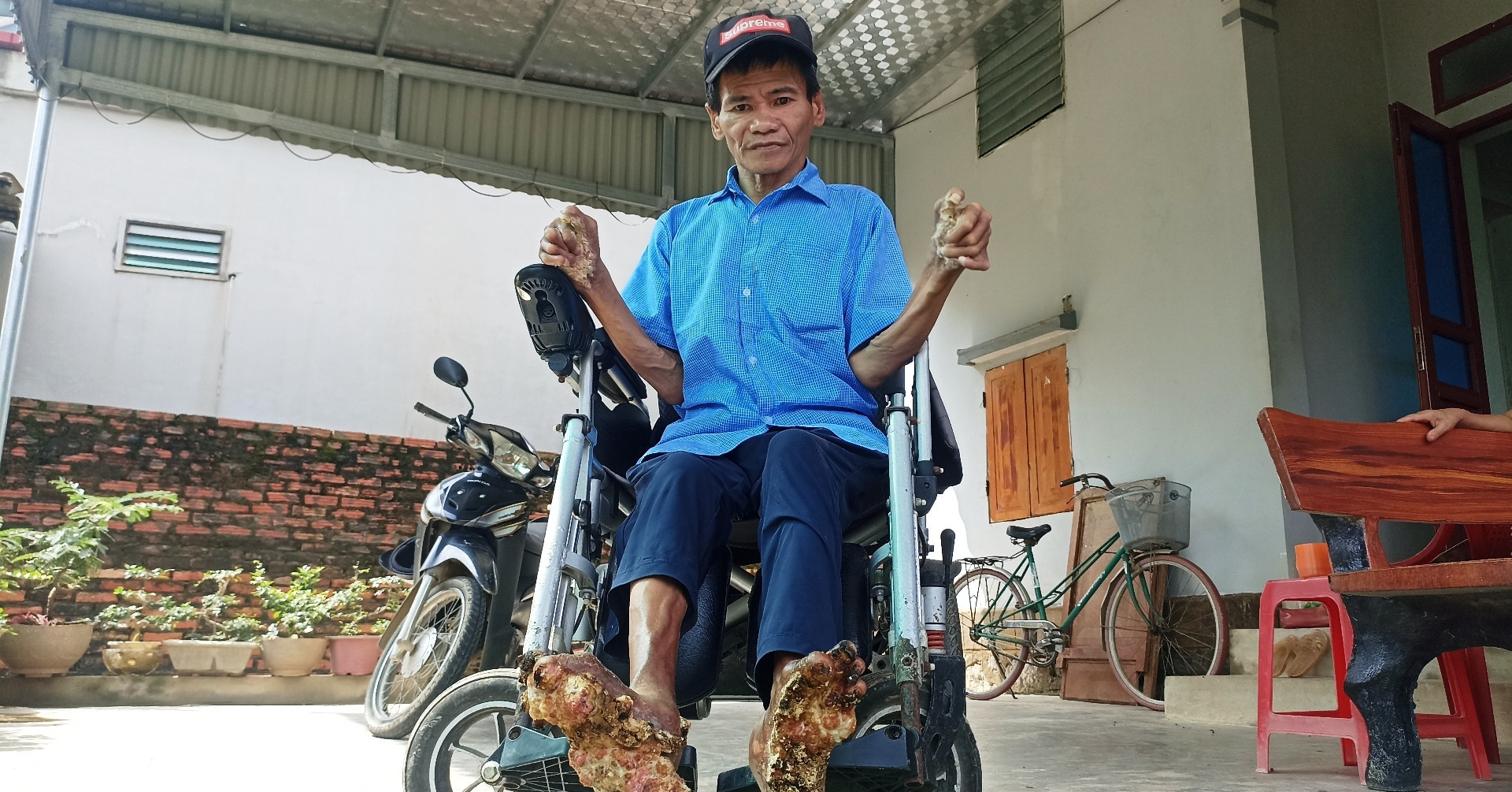 A rare life: Man in Ninh Binh lives 50 years with 'tree man syndrome'