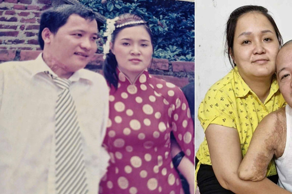 Lost 2 arms and 1 leg in an accident, man rebuilds his life with his wife's love