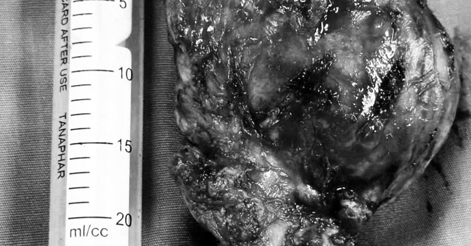 Surgeons remove giant thyroid tumor from 93-year-old woman in Ninh Binh