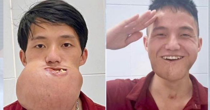 10-hour face surgery restores young man’s smile and future