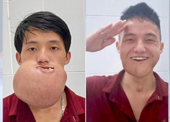 anh truoc va sau phau thua.png