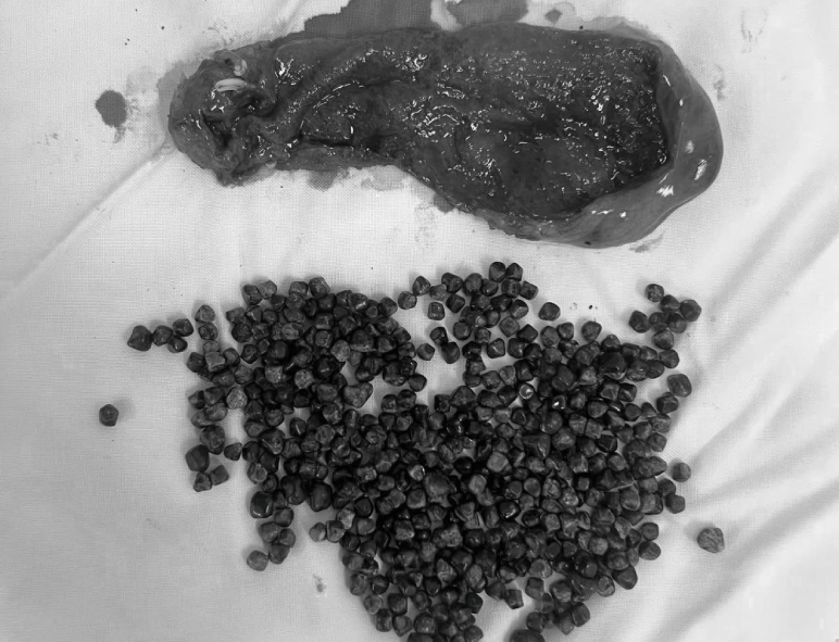 Overseas Vietnamese woman returns to VN to have dramatic gallbladder surgery