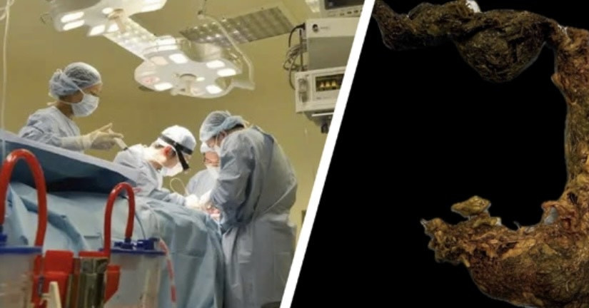 Doctors extract giant hairball blocking intestines of 9-year-old girl in HCMC