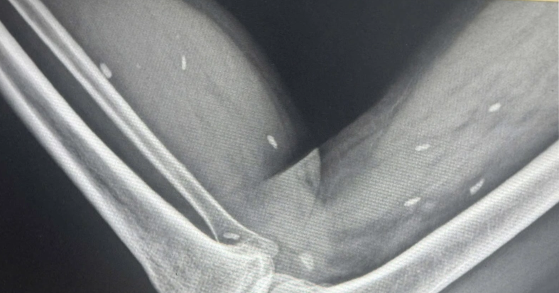 Chilling X-ray reveals parasite infestation in man who frequently ate raw food