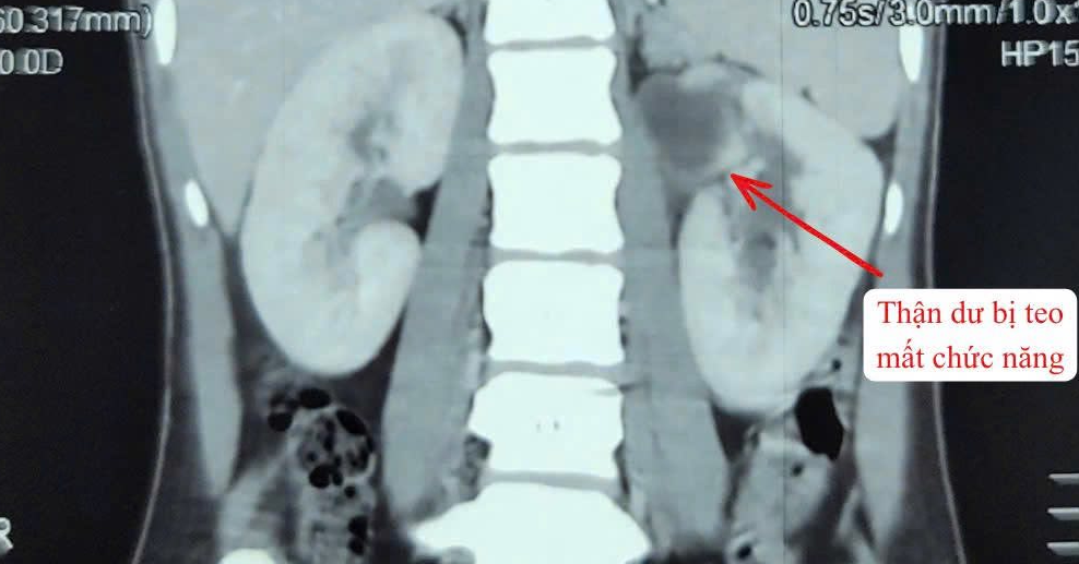 Young woman diagnosed with extremely rare triple-kidney condition