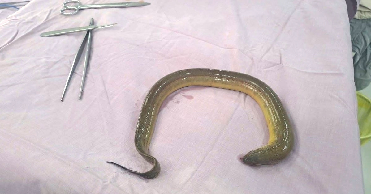 Doctors find 50cm eel inside man’s abdomen in rare emergency case