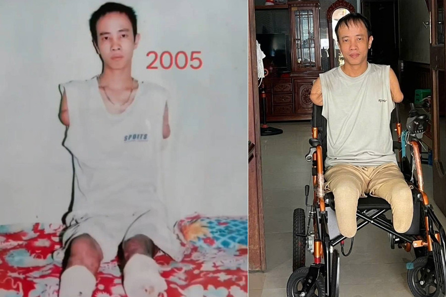 Devoted wife saves quadruple amputee from despair